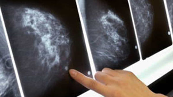 Puglia: gli effetti della pandemia sulle mammografie, il 34% in meno e 44mila esami saltati