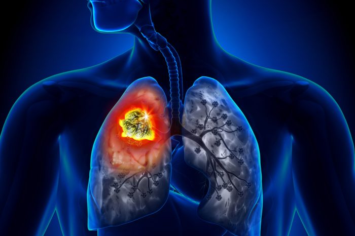 Istituto Tumori di Bari e la prevenzione del tumore al polmone