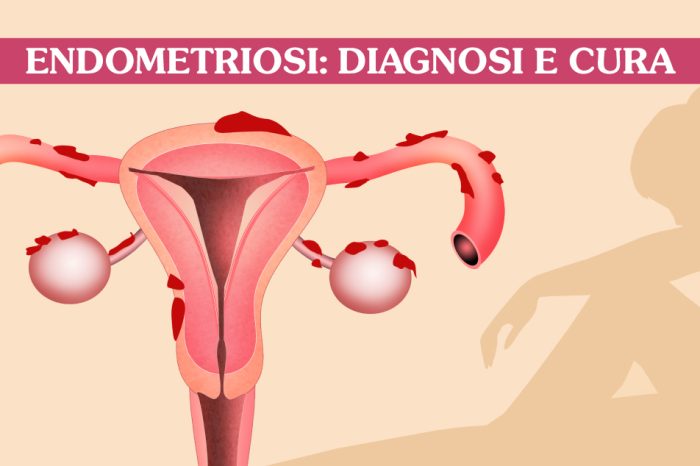 Nuove proposte chirurgiche per l'endometriosi al Policlinico di Bari