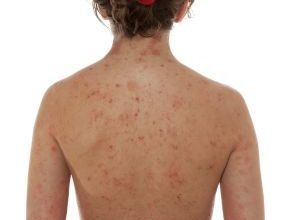 Dermatite Atopica Open Day