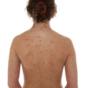 Dermatite Atopica Open Day