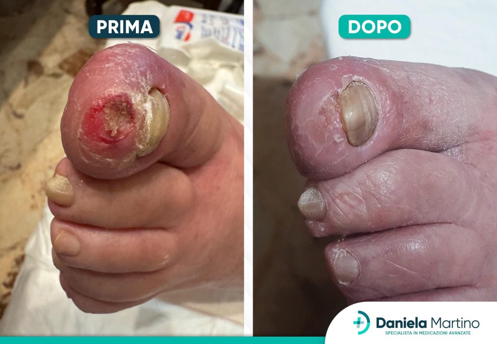 Prima e dopo la cura di un’ulcera all’alluce con medicazioni avanzate della dottoressa Daniela Martino, guarigione completa senza amputazione"