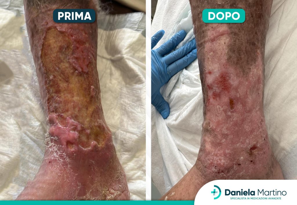 Prima e dopo la cura di un’ulcera venosa alla gamba con medicazioni avanzate della dottoressa Daniela Martino, evidente miglioramento e guarigione progressiva