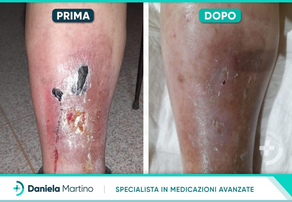 Prima e dopo la cura di una ferita cronica alla gamba con medicazioni avanzate della dottoressa Daniela Martino, guarigione evidente e pelle ristabilita