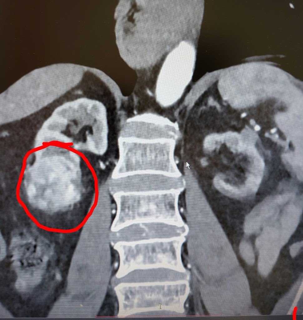 L'immagine attuale non ha un testo alternativo. Il nome del file è: Intervento-oncologia-renale-Urologia-Altamura-2.jpeg